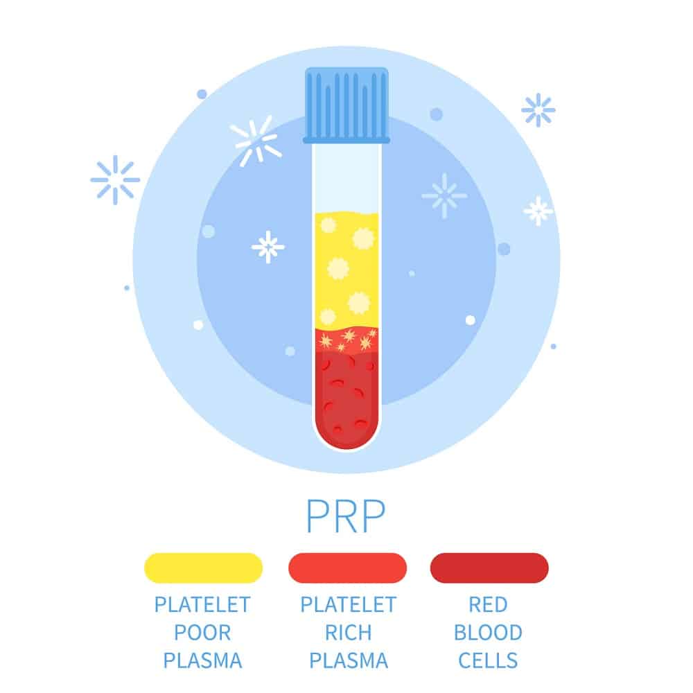 platelet-rich plasma