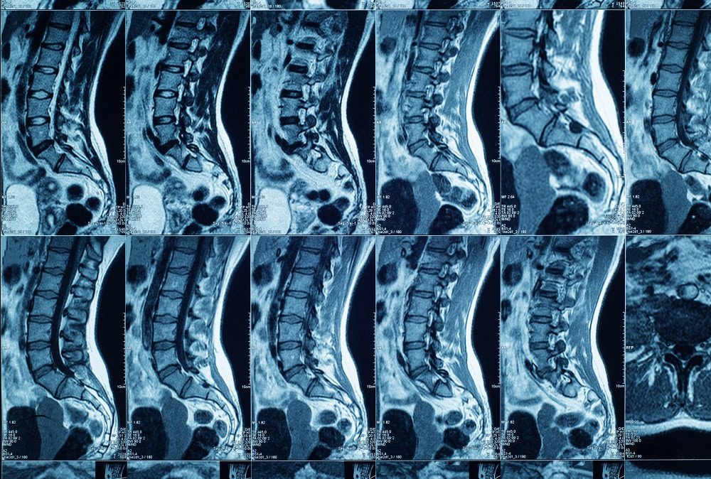 MRIs and their Roles with PT