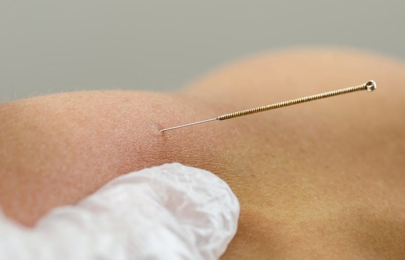 Tigger Point Dry Needling