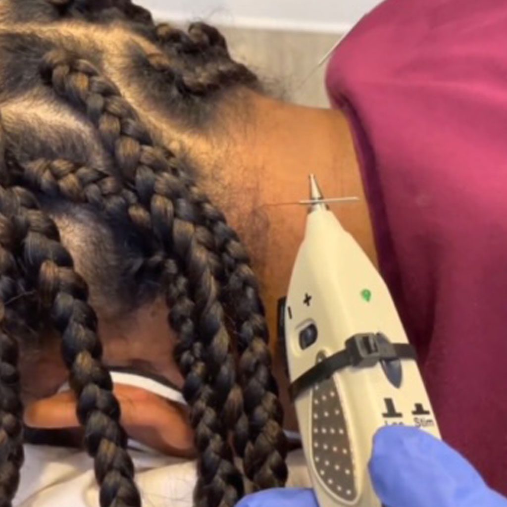 dry-needling